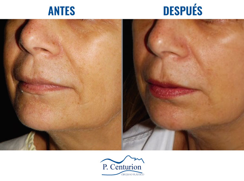 Lifting facial tercio inferior