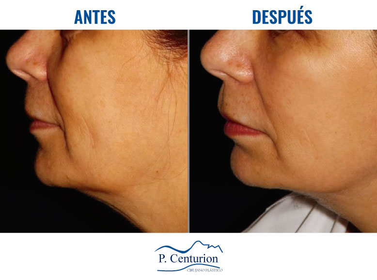 Lifting facial tercio inferior