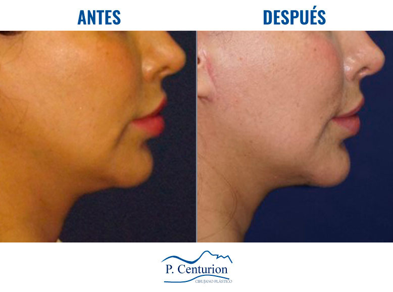 Lifting facial tercio inferior