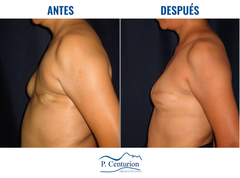 Reconstruccion mamaria con Células Madre