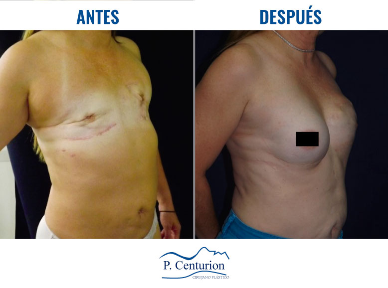 Reconstruccion mamaria con Células Madre