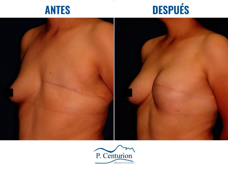 Reconstruccion mamaria con Células Madre