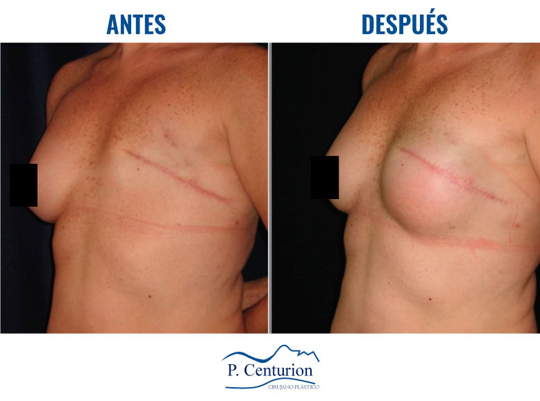 Reconstruccion mamaria con Células Madre