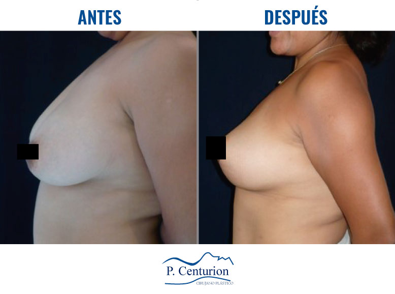 Reduccion y levantamiento mamario en Lima-Peru Dr.Centurion